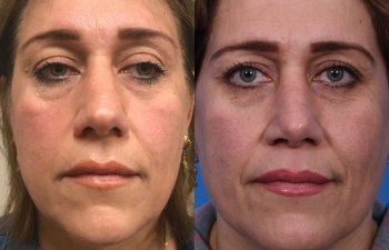 female patient before and after rhinoplasty - front
