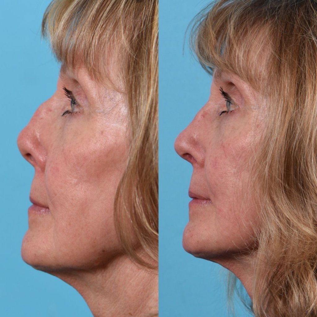female patient before and after rhinoplasty - left side