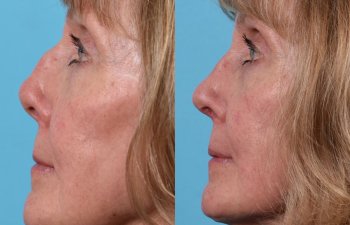 female patient before and after rhinoplasty - left side