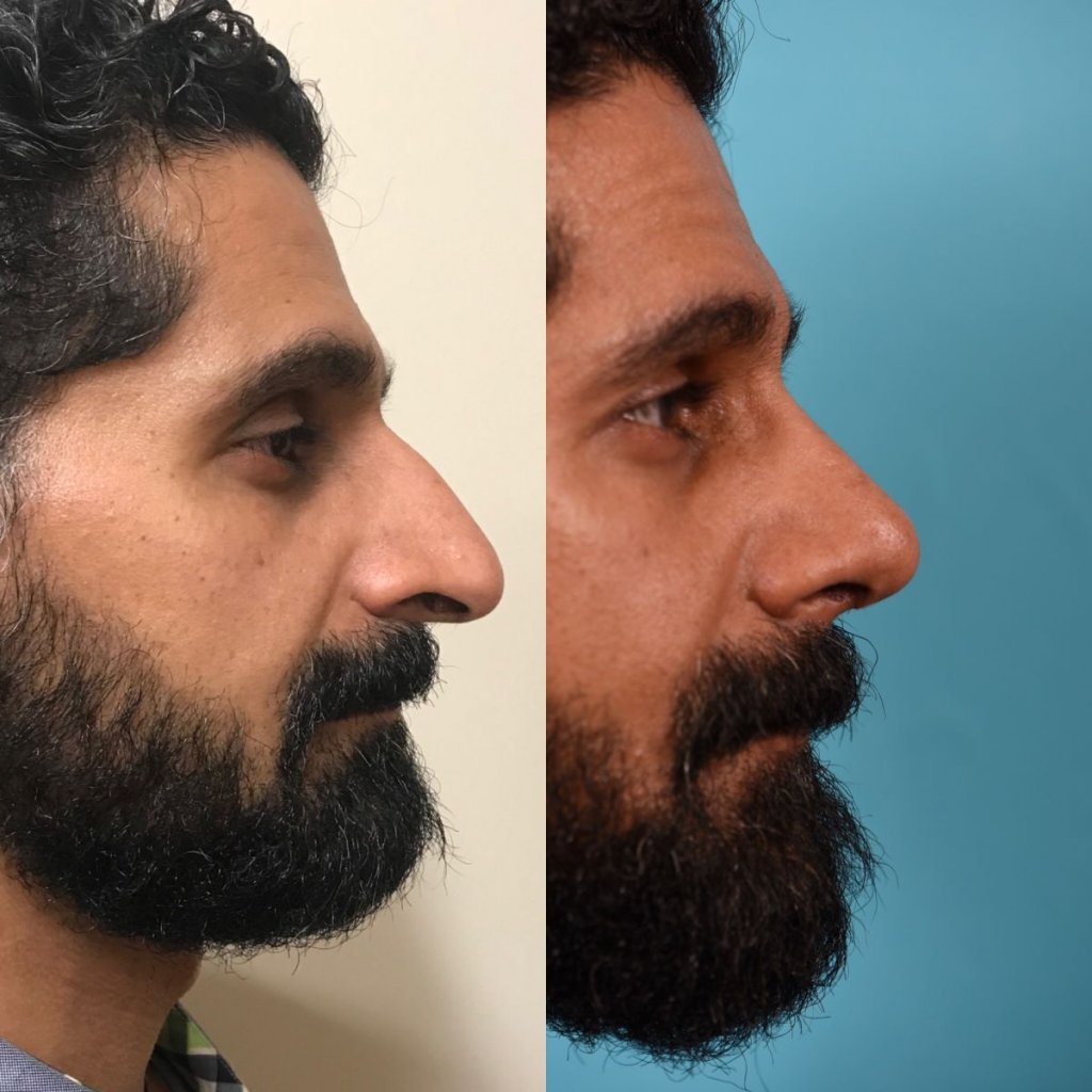male patient before and after rhinoplasty - right side