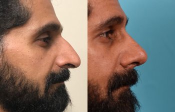 male patient before and after rhinoplasty - right side