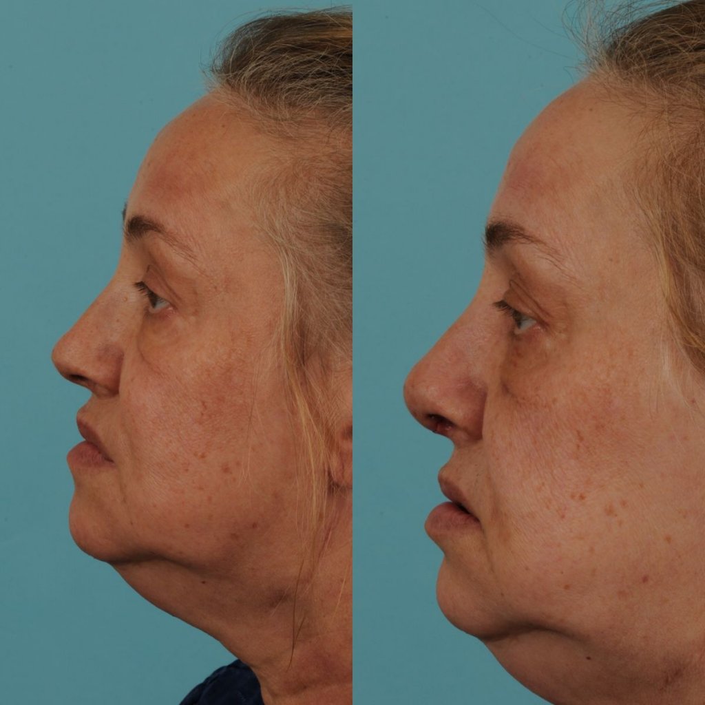 female patient before and after rhinoplasty - left side