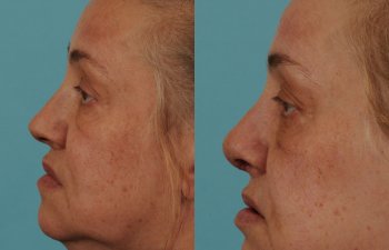 female patient before and after rhinoplasty - left side