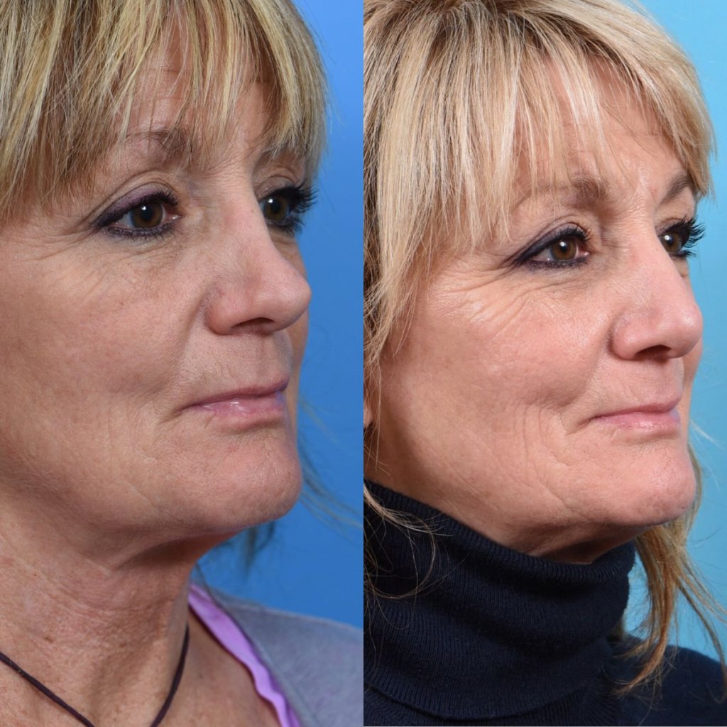 female patient before and after rhinoplasty - right side