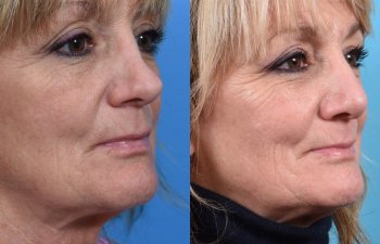 female patient before and after rhinoplasty - right side