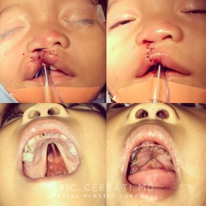 baby patient before and after cleft lip and palete repair surgery