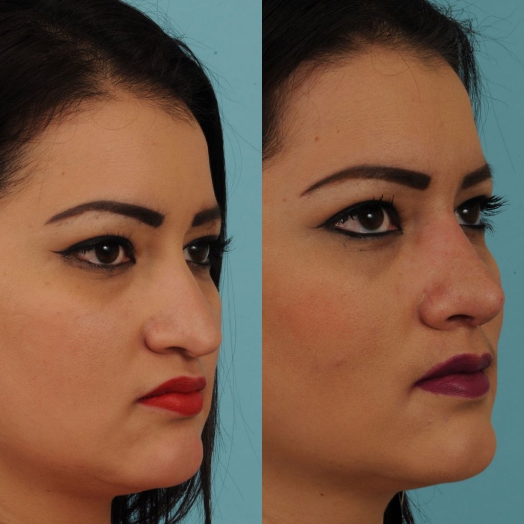 female patient before and after rhinoplasty - right side