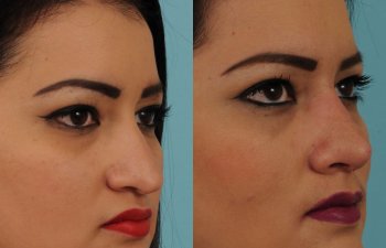 female patient before and after rhinoplasty - right side