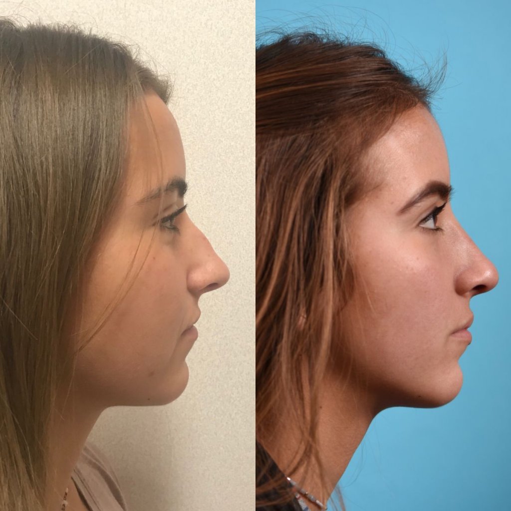 female patient before and after rhinoplasty - right side