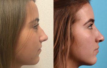 female patient before and after rhinoplasty - right side