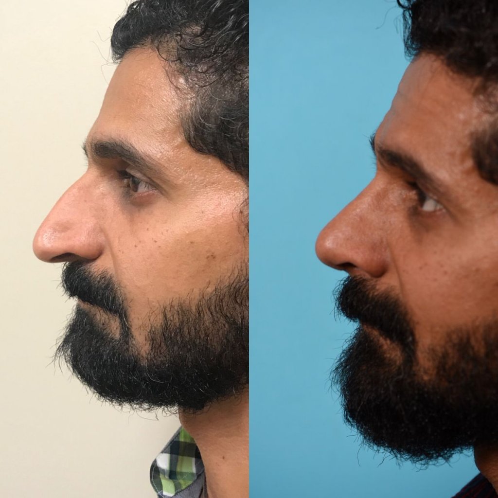 male patient before and after rhinoplasty - left side