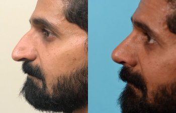 male patient before and after rhinoplasty - left side