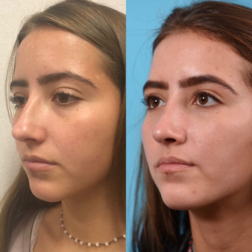 female patient before and after rhinoplasty - left side