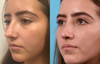 female patient before and after rhinoplasty - left side