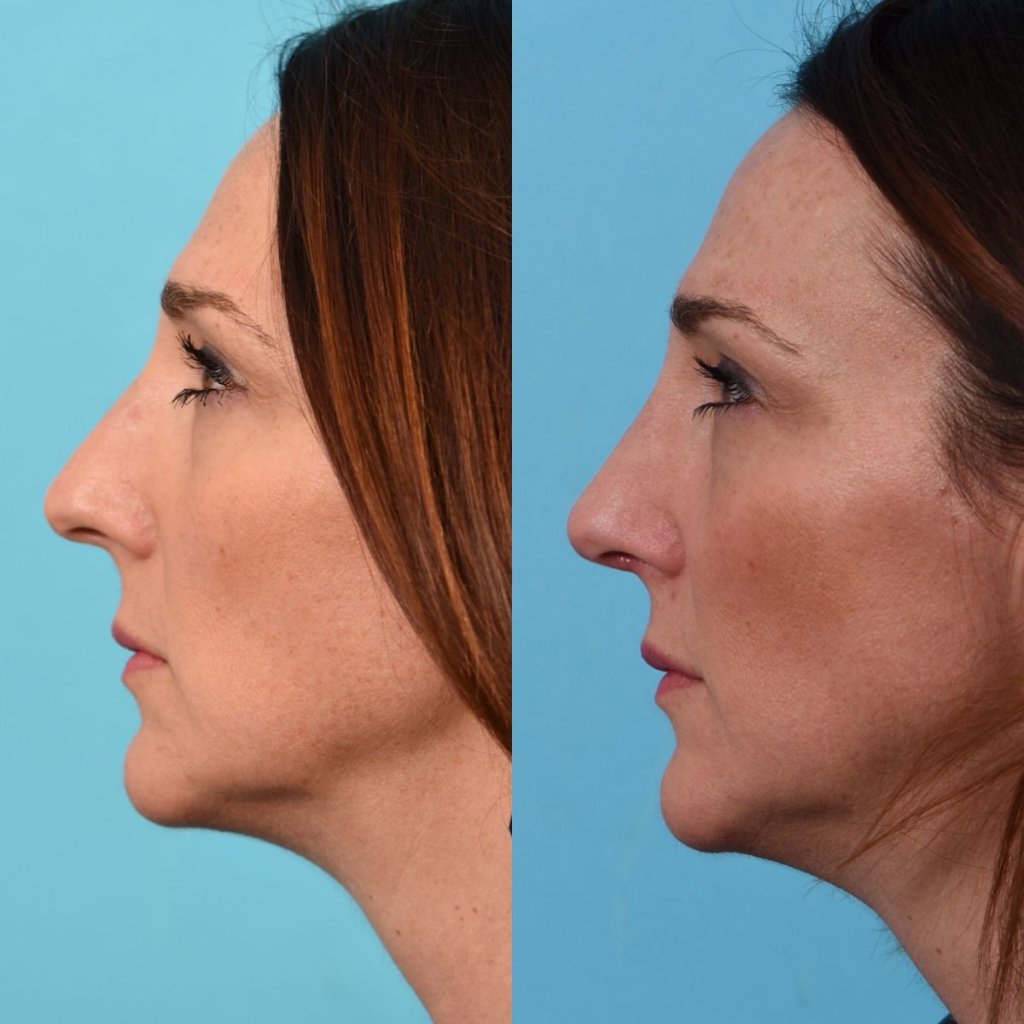 female patient before and after rhinoplasty - left side