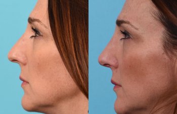 female patient before and after rhinoplasty - left side
