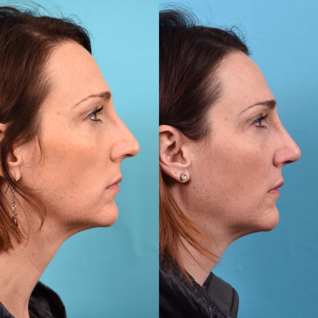 female patient before and after rhinoplasty - right side