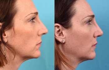 female patient before and after rhinoplasty - right side