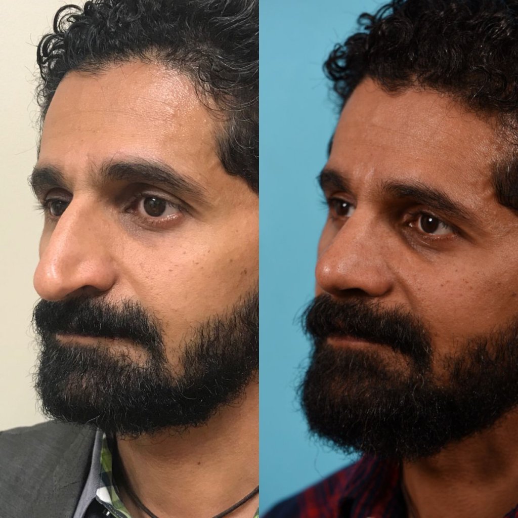 male patient before and after rhinoplasty - left side