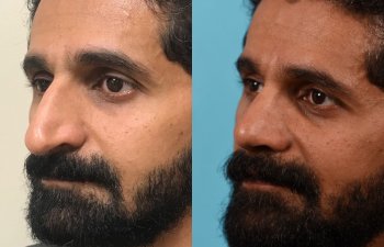 male patient before and after rhinoplasty - left side