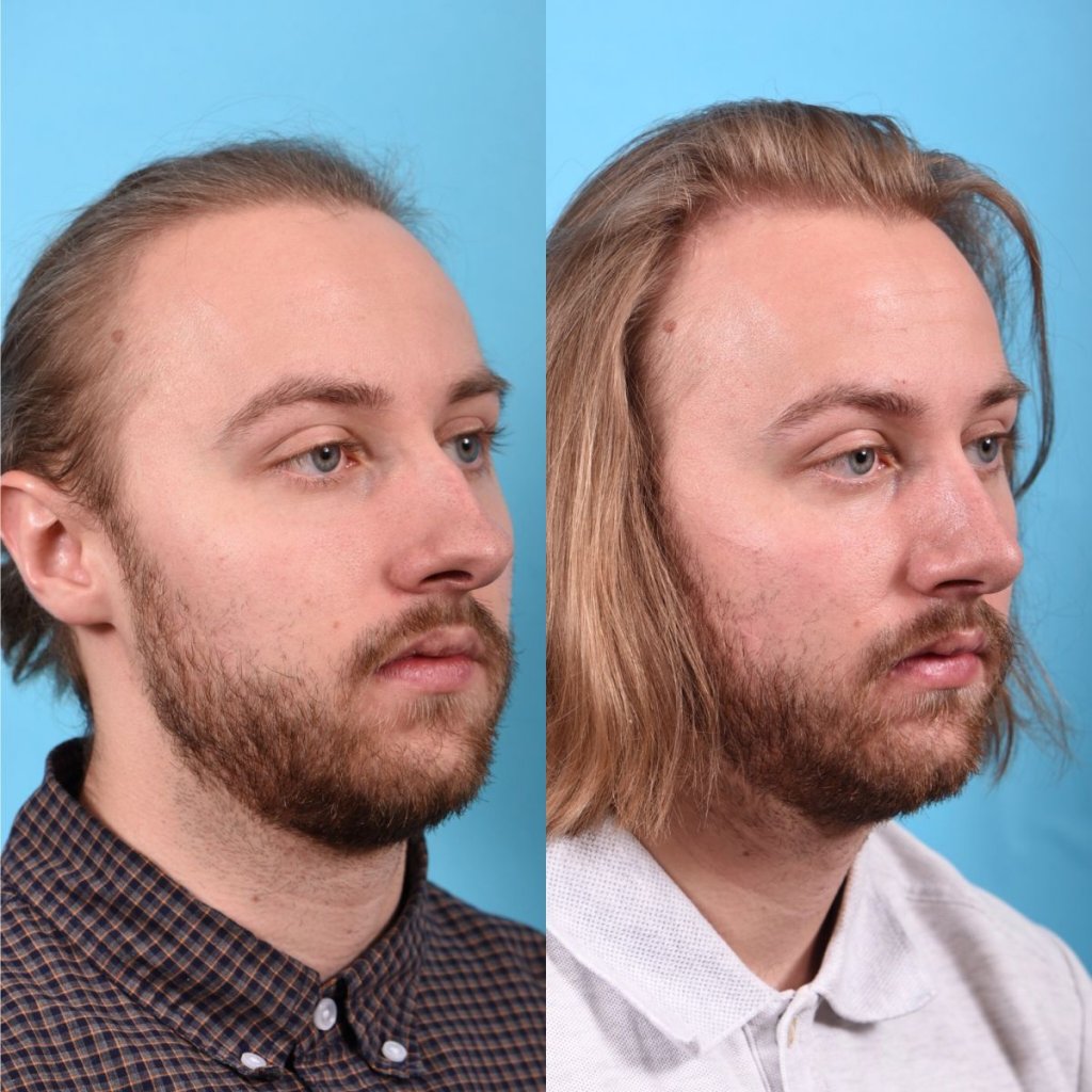 male patient before and after rhinoplasty - right side