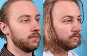 male patient before and after rhinoplasty - right side