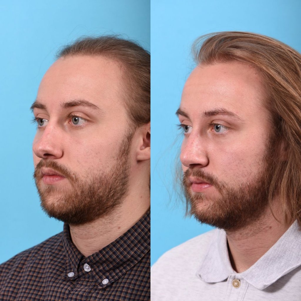 male patient before and after rhinoplasty - left side