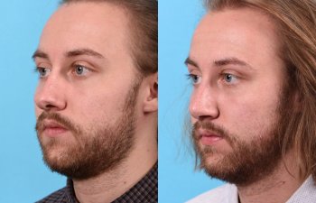male patient before and after rhinoplasty - left side