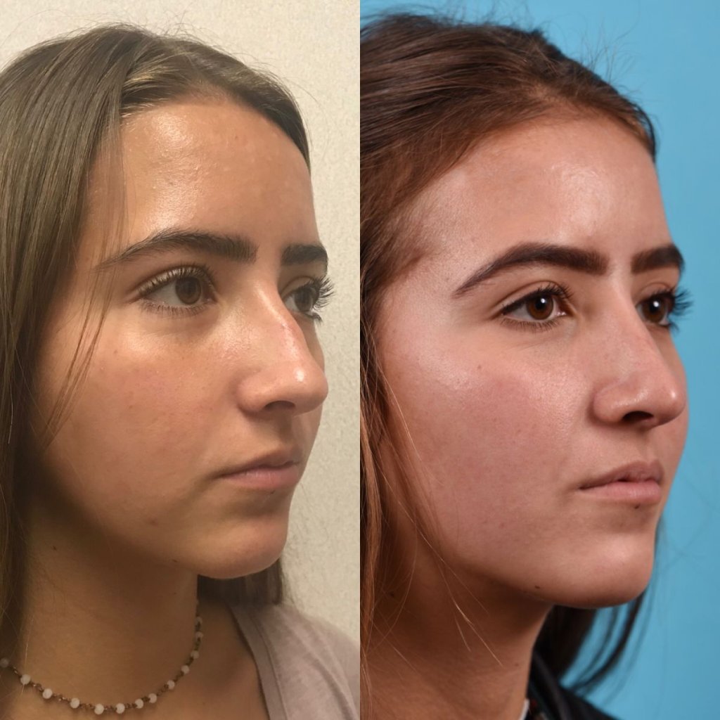 female patient before and after rhinoplasty - right side