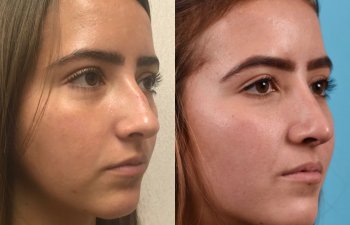 female patient before and after rhinoplasty - right side