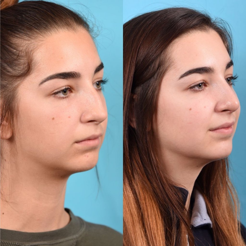 teenage female patient before and after rhinoplasty - right side