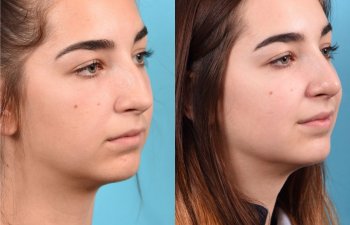 teenage female patient before and after rhinoplasty - right side
