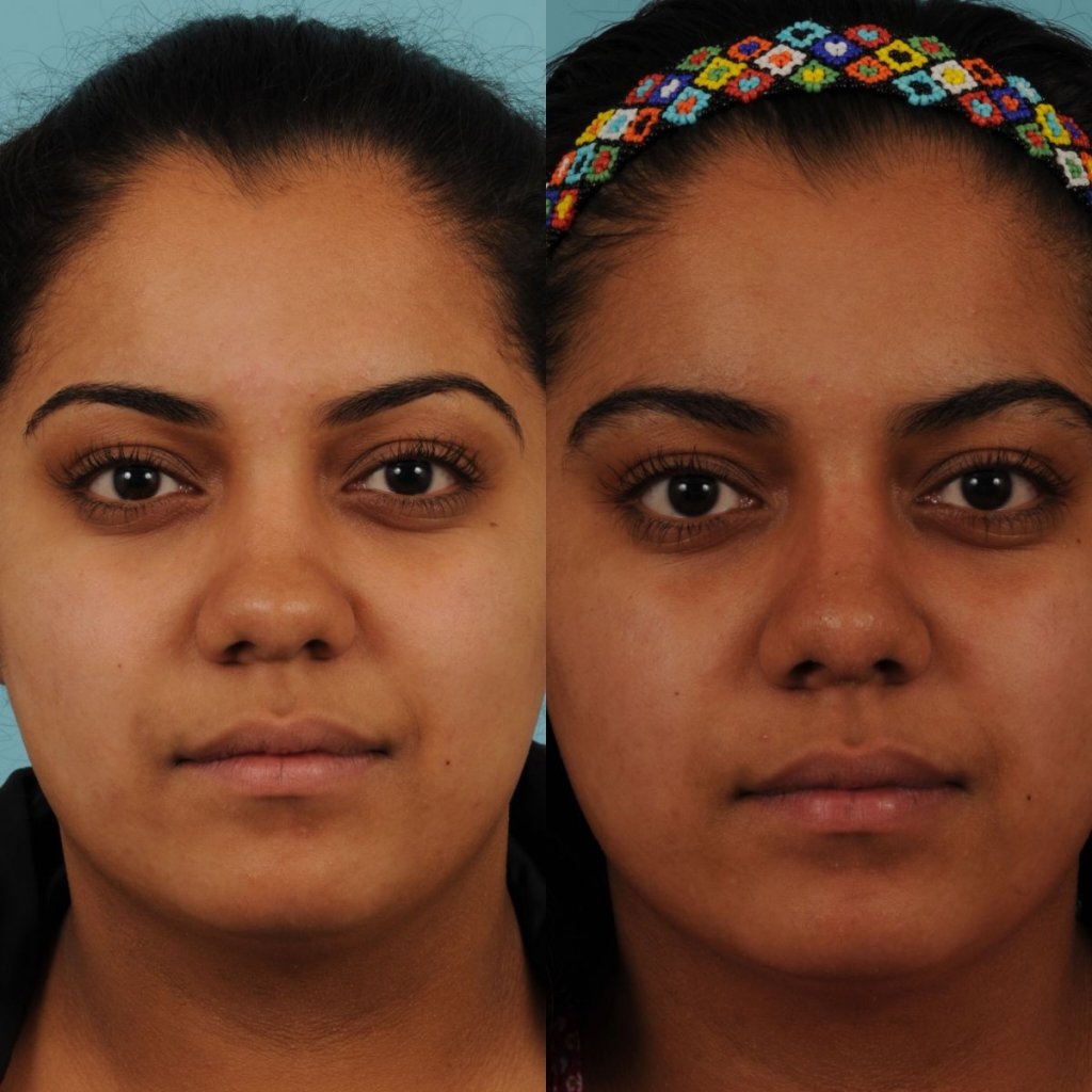 female patient before and after rhinoplasty - front