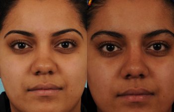 female patient before and after rhinoplasty - front
