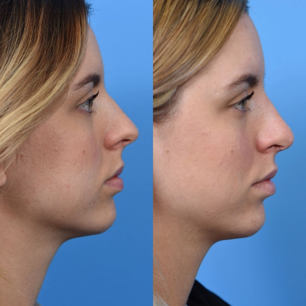 young female patient before and after rhinoplasty - righ side