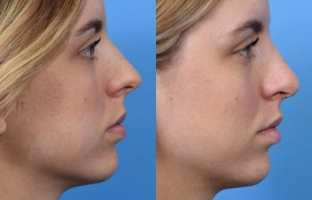 young female patient before and after rhinoplasty - righ side