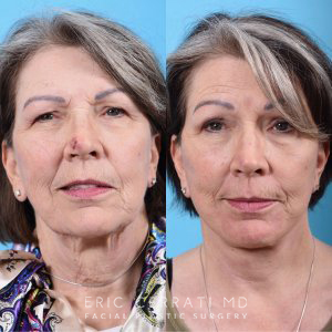 female patient before and after facial laser procedures