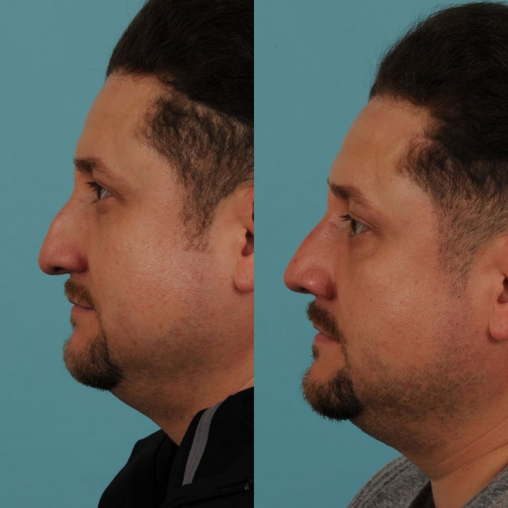 male patient before and after rhinoplasty - left side