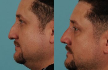 male patient before and after rhinoplasty - left side