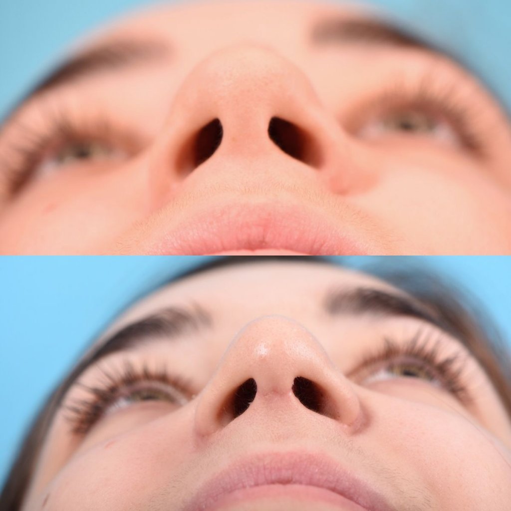 teenage female patient before and after rhinoplasty - front