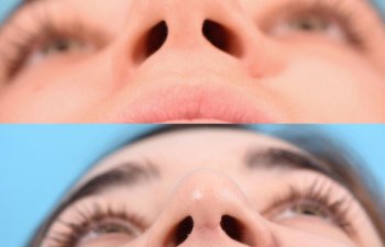 teenage female patient before and after rhinoplasty - front
