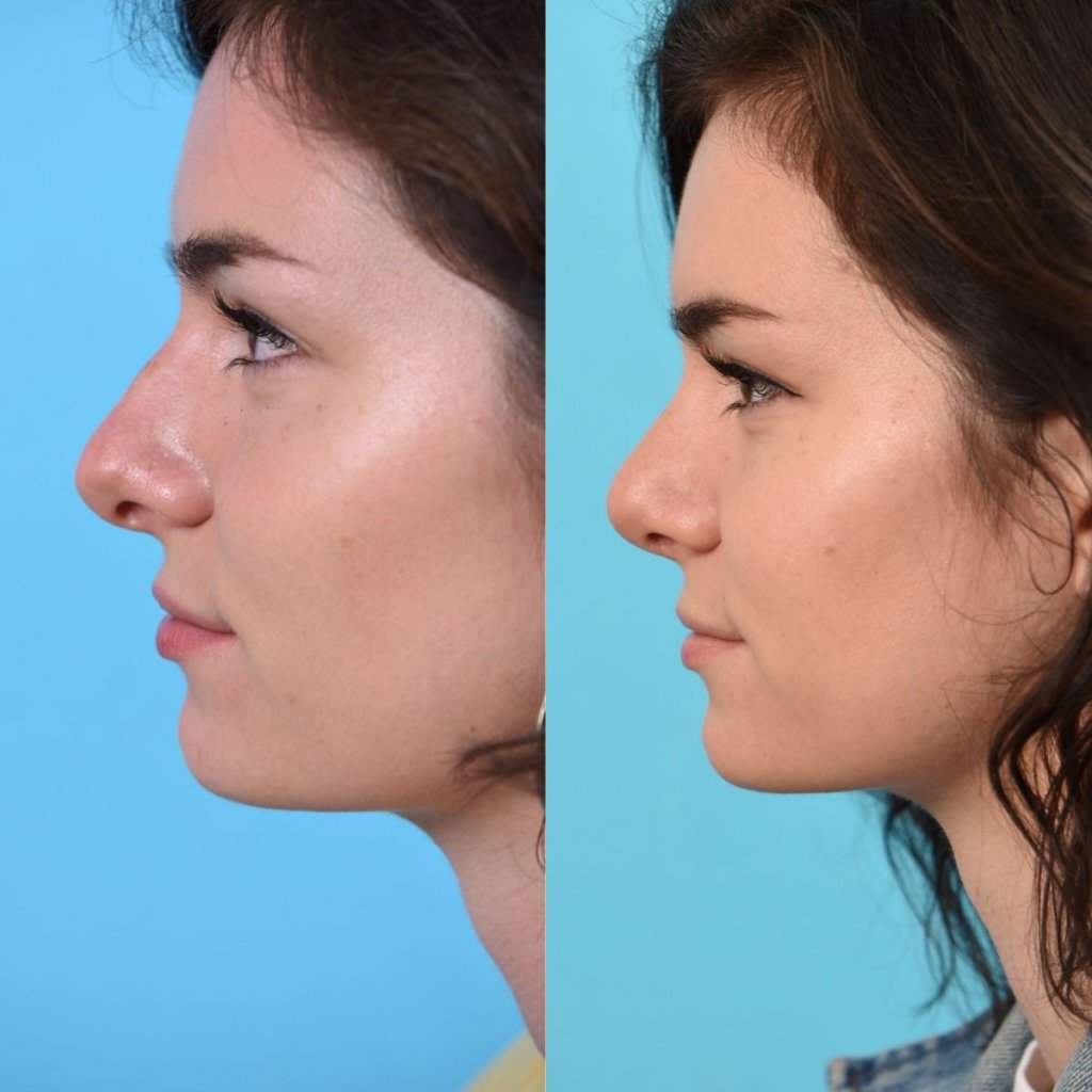 female patient before and after rhinoplasty - left side