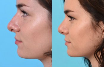 female patient before and after rhinoplasty - left side