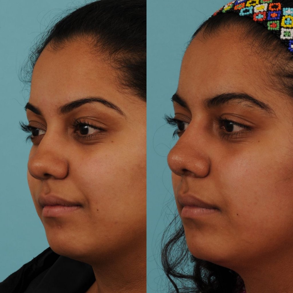 female patient before and after rhinoplasty - left side