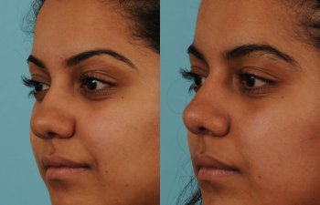 female patient before and after rhinoplasty - left side