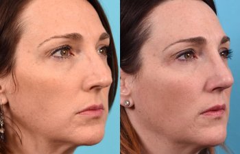 female patient before and after rhinoplasty - righ side