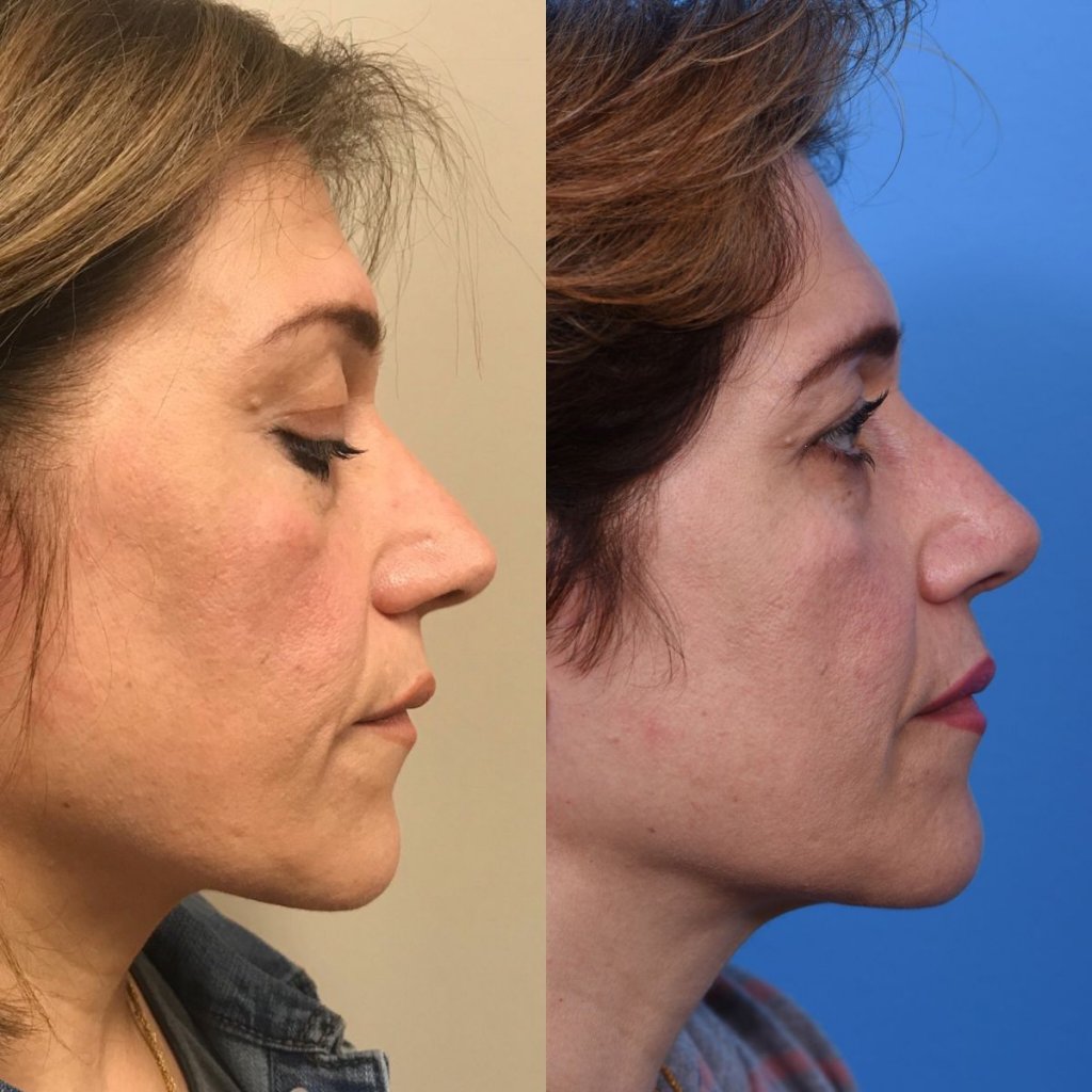 female patient before and after rhinoplasty - right side