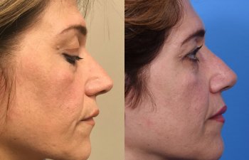 female patient before and after rhinoplasty - right side