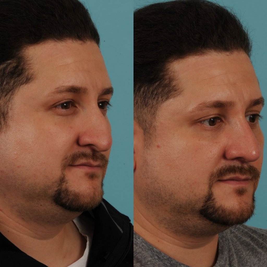 male patient before and after rhinoplasty - right side