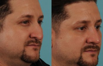 male patient before and after rhinoplasty - right side